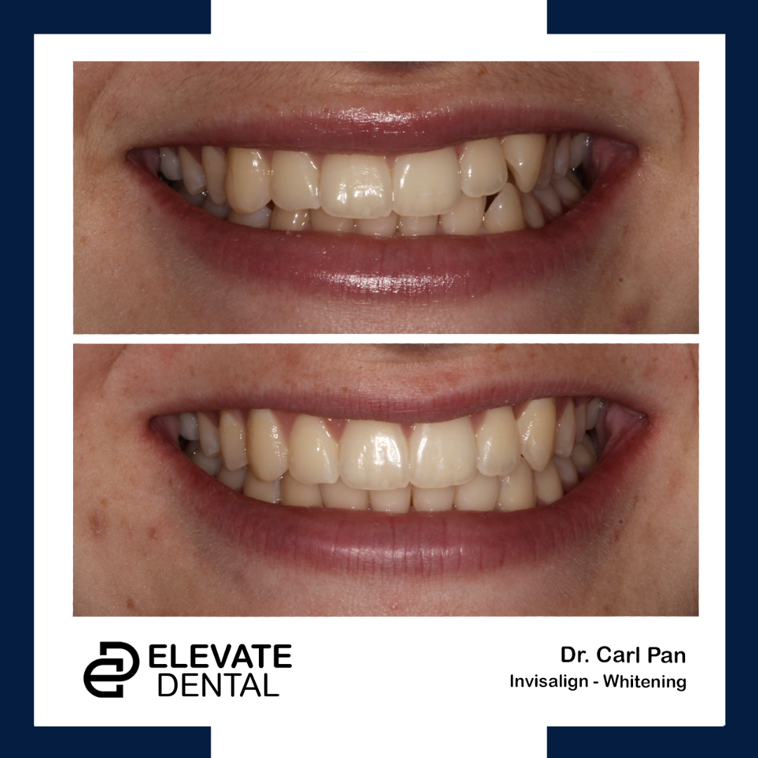 dental cleaning