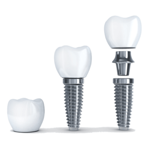 dental implants wagga wagga