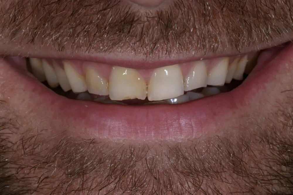 Before