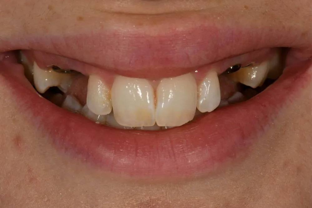 Before