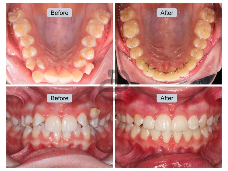 Expander & Braces 