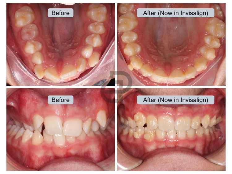 Expander & Invisalign