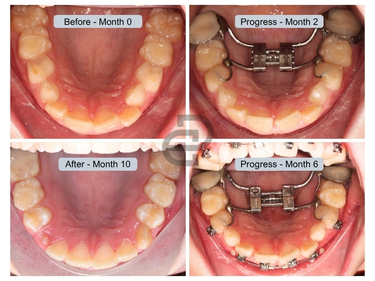 Expander & Partial Braces 
