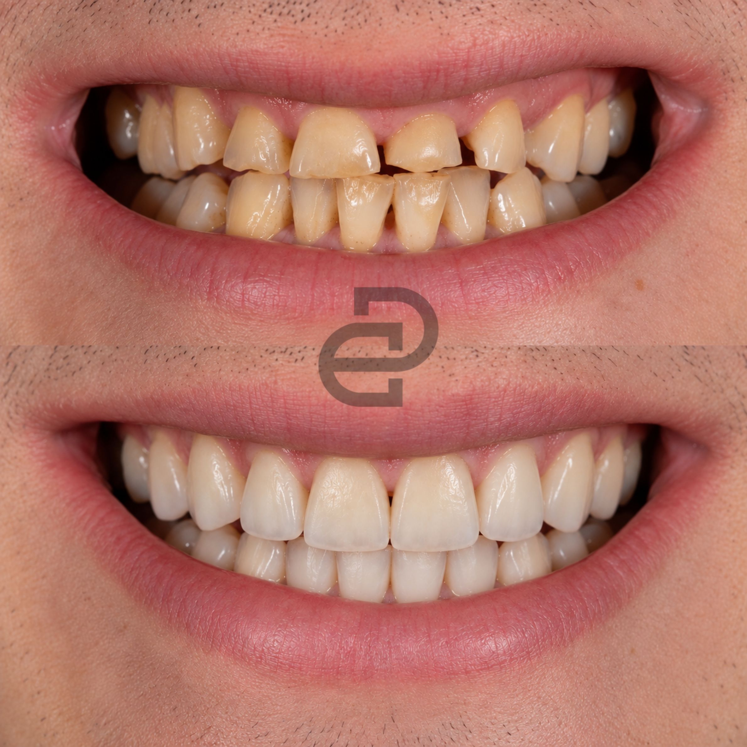 Crowns & Veneers